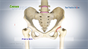 Labral Tears of the Hip