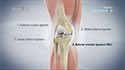 ACL Reconstruction Patellar Tendon