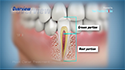 Root Canal Treatment