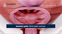 Interstitial Cystitis