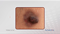 Melanoma