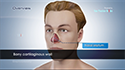 Septoplasty