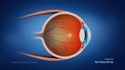 Retinal Detachment