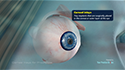 Corneal Inlays for Presbyopia