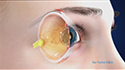 Intraocular Lenses (IOL)