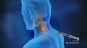 Cervical Spine Injections
