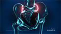 Sacroiliac Joint Pain