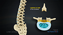 Lumbar Laminectomy