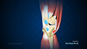 Pes Anserine Bursitis