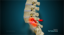 Spondylolisthesis