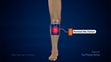 Tibia Fractures in Children