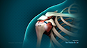 Rotator Cuff Repair