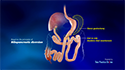 Single Anastomosis Duodeno-ileal Bypass with Sleeve Gastrectomy (SADI-S)