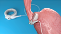 Laparoscopic Adjustable Gastric Banding