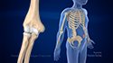 Pediatric Supracondylar Fractures