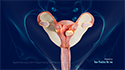 Hysteroscopy with Polypectomy and Fibroid removal