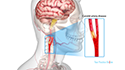 Transcarotid Artery Revascularization (TCAR)