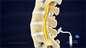 Lumbar Puncture