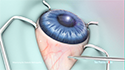 Vitrectomy for Diabetic Retinopathy