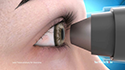 Laser Trabeculoplasty for Glaucoma