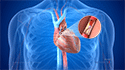 Coronary Artery Bypass Graft Surgery