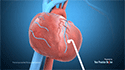 Transmyocardial Revascularization (TMR)