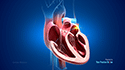 Cardiac Ablation