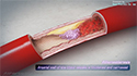 Atherosclerosis