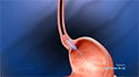 Achalasia Dilation