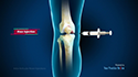 Intra-articular Knee Injections