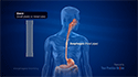 Esophageal Stenting