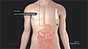 PEG/PEJ Procedure