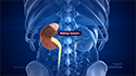 Kidney Tumors