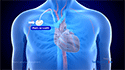 Port Catheter Placement