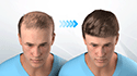 Hair Transplantation