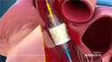 Aortic Valve Replacement or TAVR