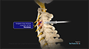 Posterior Cervical Foraminotomy