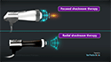 Focused Shockwave Therapy