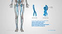 Endovenous Laser Therapy