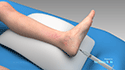 Sclerotherapy