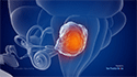 Acoustic Neuroma