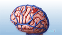 Brain AVM