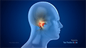 TMJ Disorders