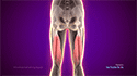 Proximal Hamstring Repair