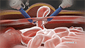 Ventral Hernia Repair