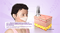 Microdermabrasion