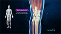 Minimally-Invasive Quadriceps-Sparing Total Knee Replacement