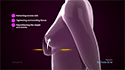 Breast Lift