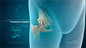 Robotic Hip Replacement