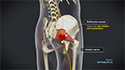 Piriformis Syndrome